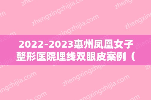 2024惠州凤凰女子整形医院埋线双眼皮案例（惠州市割双眼皮哪里好）